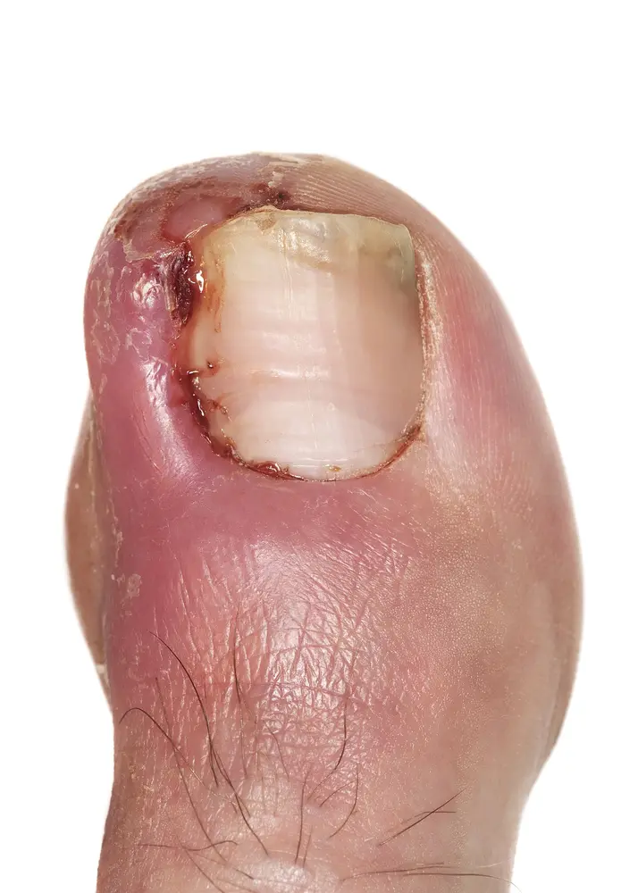 My toe nail is ingrown or is it??? - Belfast Lower Limb Clinics