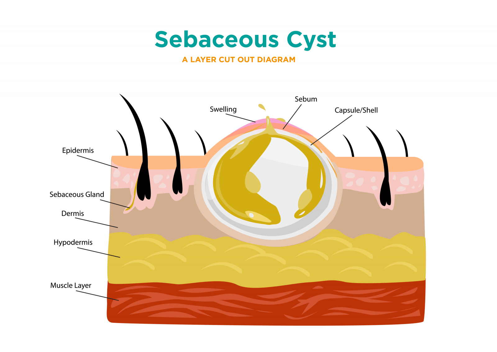 Sebaceous Cyst 1