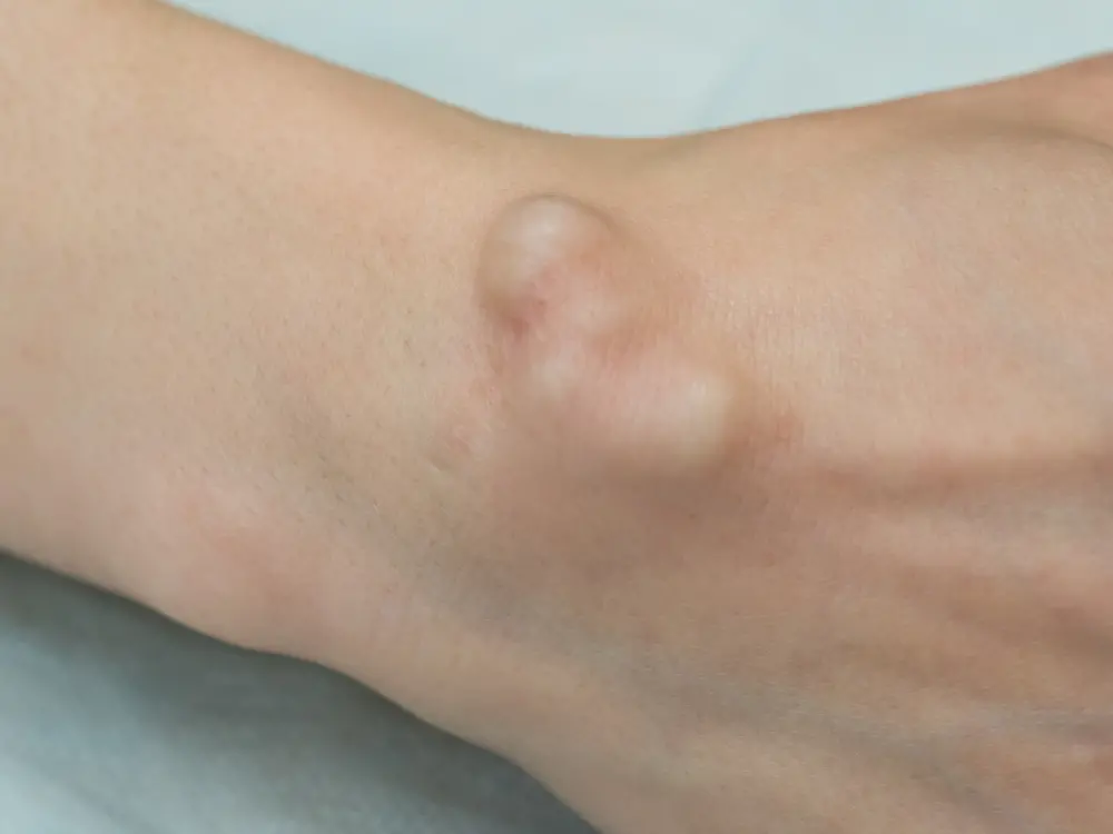 Ganglion Cyst - Carpal Tunnel Surgery Clinic