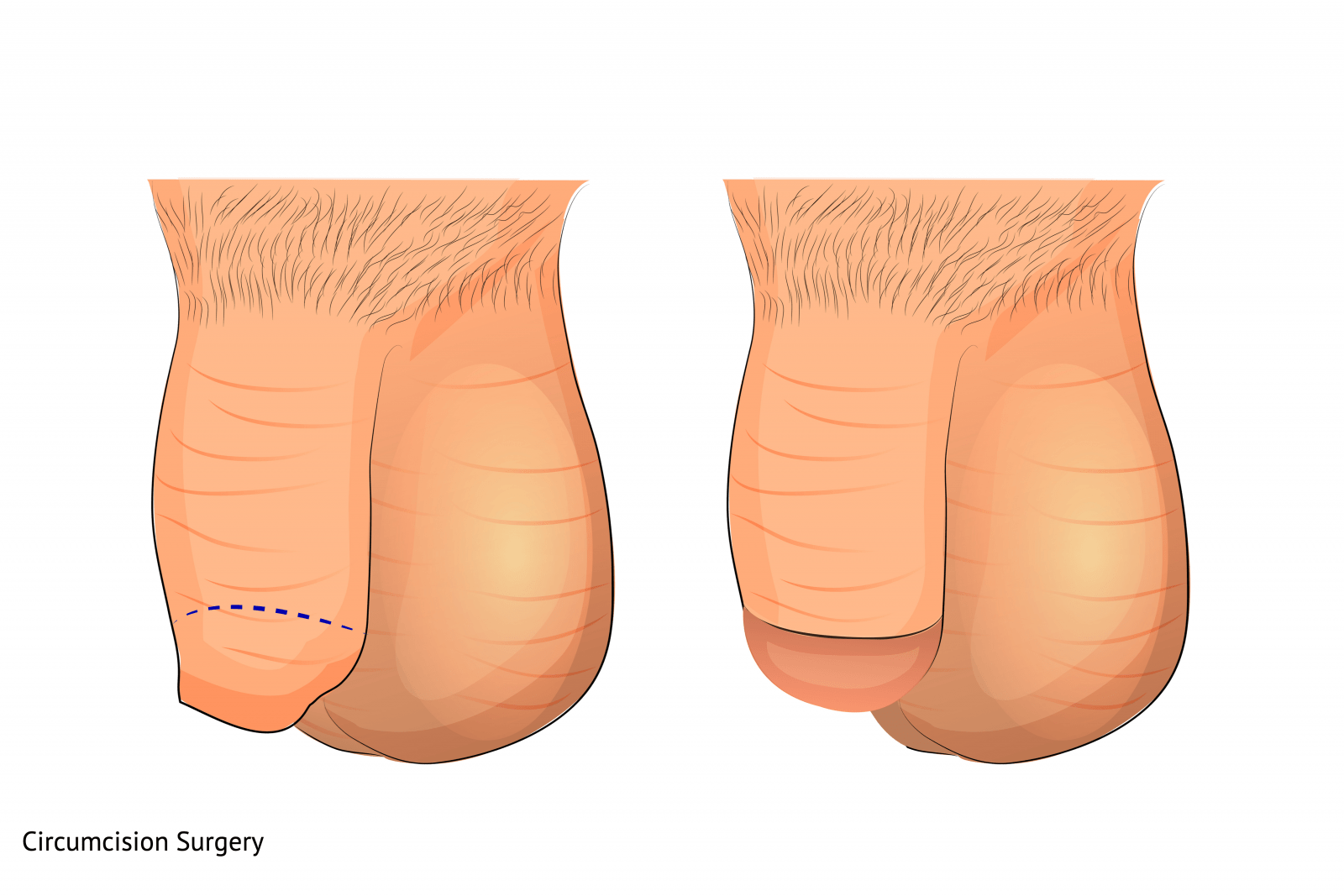 circumcision-surgery-before-and-after-diagrams